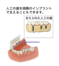 部分入れ歯に対するインプラント