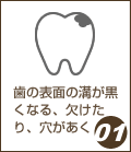 歯の表面の溝が黒くなる、欠けたり、穴があく