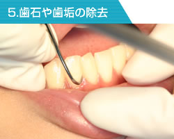 歯石や歯垢の除去