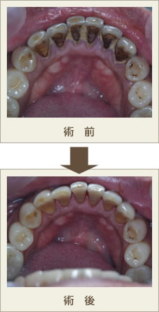 クリーニング、PMTC、術前、術後画像
