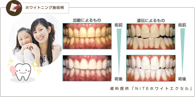 ホワイトニング施術例